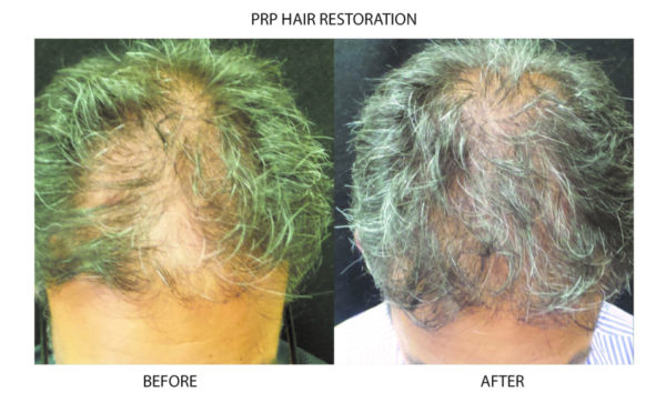 PRP Microneedling and Hair Restoration | New York City ...