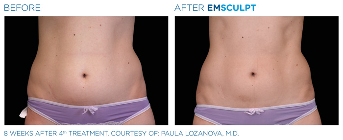 Emsculpt_PIC_Ba-card-female-abdomen