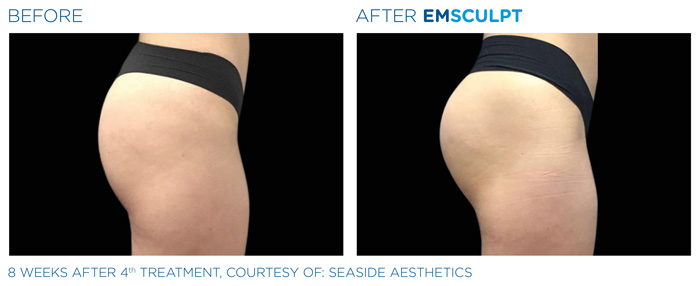 Emsculpt_PIC_Ba-card-female-buttock